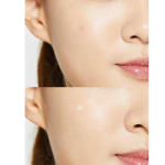 Μάσκα προσώπου για την ακμή        COSRX - Image 2